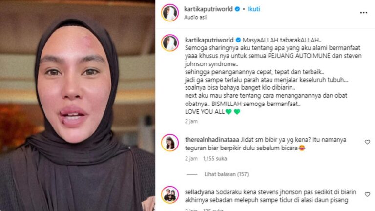 Alasan Kartika Putri Memilih Pengobatan Stevens-Johnson Syndrome di Singapura