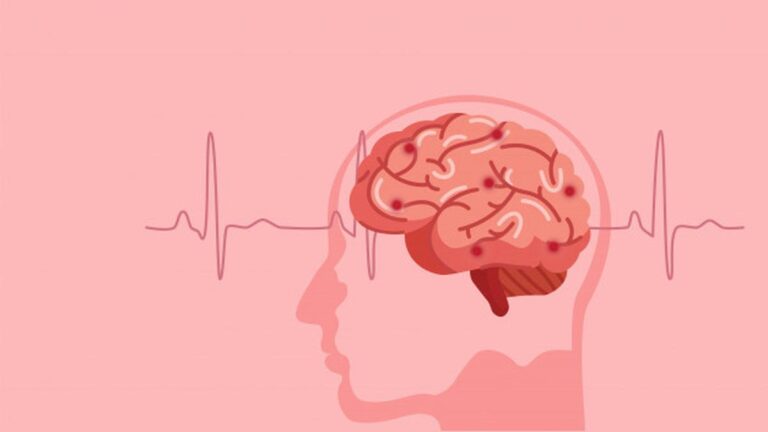 Gejala Stroke Hemoragik: Perdarahan Otak Akibat Pembuluh Darah Pecah