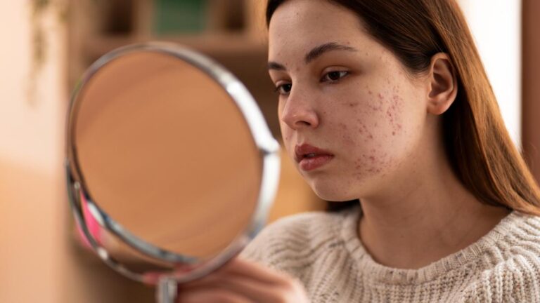 Skin Purging vs Breakout: Bedanya yang Perlu Kamu Ketahui